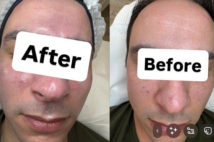 Laser perfection